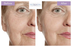 Profhilo Skin Booster