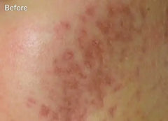 MicroNeedling Skin Pen