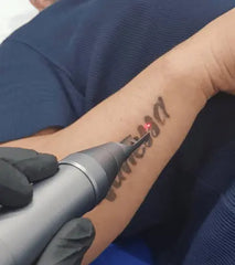 Laser Tattoo Removal