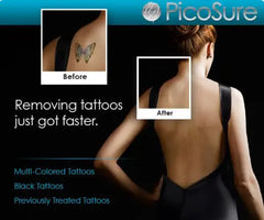 Laser Tattoo Removal