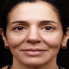 Radio Frequency Face Tightening