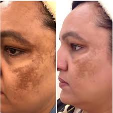 NanoSure Pigmentation Removal