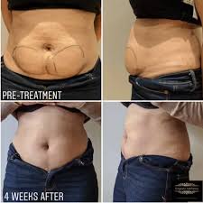 Aqualix-fat dissolving treatment