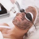 Carbon Laser Peel Treatment