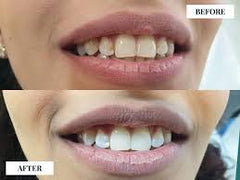 Laser Teeth Whitening Sessions