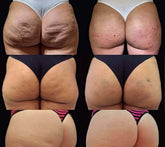 Cellulite Reduction
