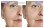 Profhilo Skin Booster