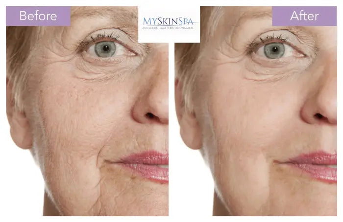 Profhilo Skin Booster