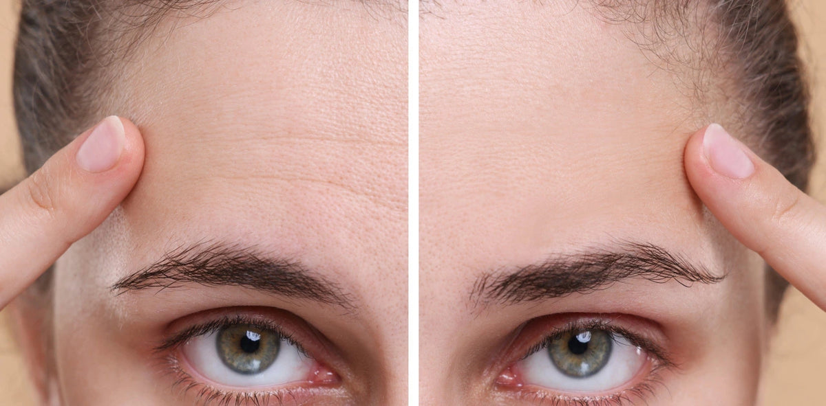 Forehead Lines Treatment