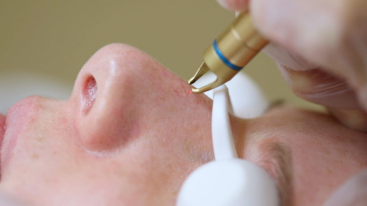 3D Vasculase Treatment