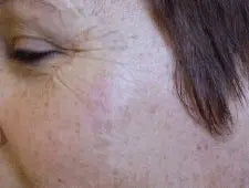 Skin Tag Removal