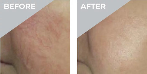 3D Vasculase Treatment