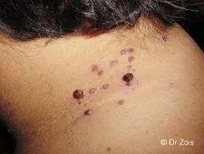 Skin Tag Removal