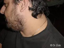 Skin Tag Removal