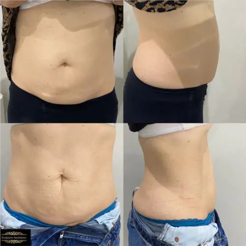 Aqualix-fat dissolving treatment