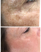 NanoSure Pigmentation Removal