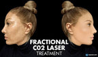 Co2 Laser Skin Rejuvenation