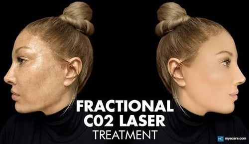 Co2 Laser Skin Rejuvenation