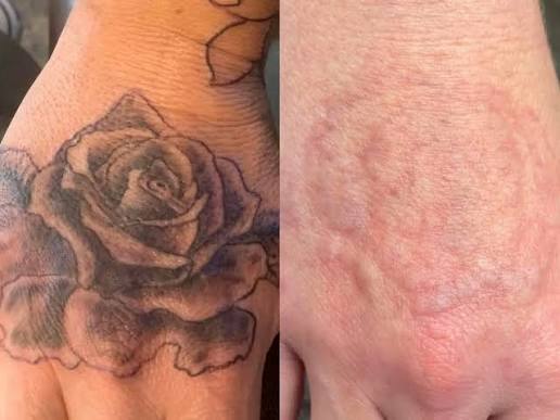 Tattoo Removal Pico Laser