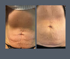 Radio Frequency Body Tightening Caring