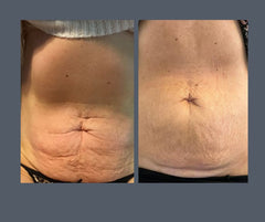 Radio Frequency Body Tightening Caring