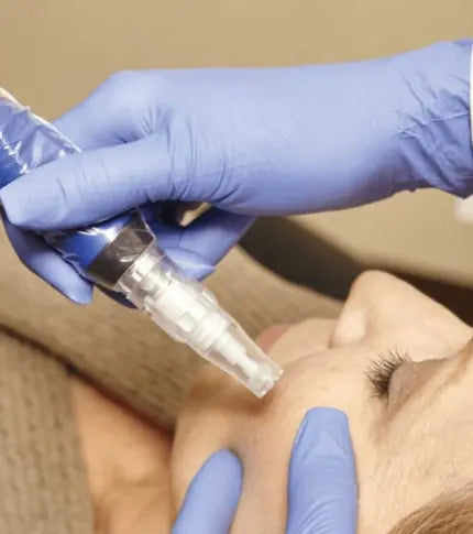 MicroNeedling Skin Pen