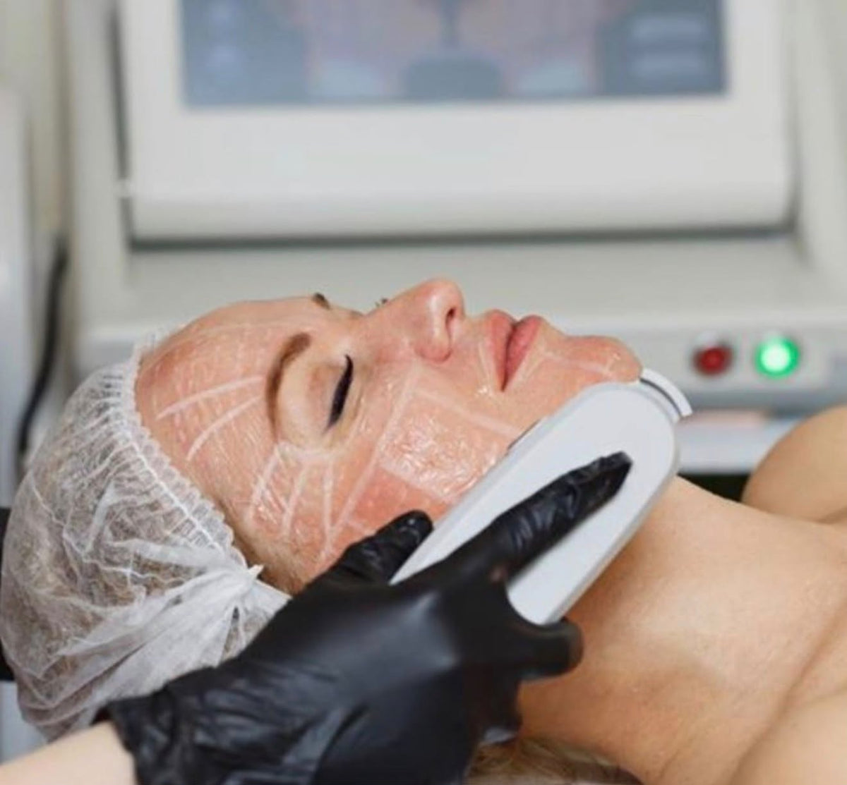 Body HIFU Treatment