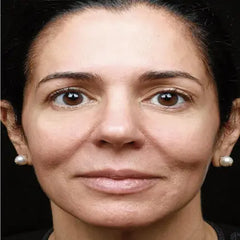 Radio Frequency Face Tightening