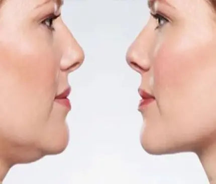 Double Chin Reduction