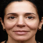 Radio Frequency Face Tightening