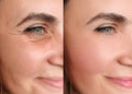 Crow’s Feet Treatment