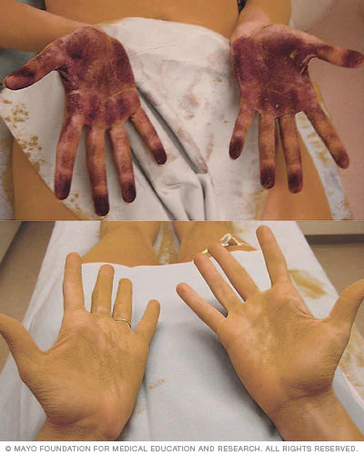 HyperHidrosis Treatment