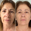 Non-Surgical HIFU