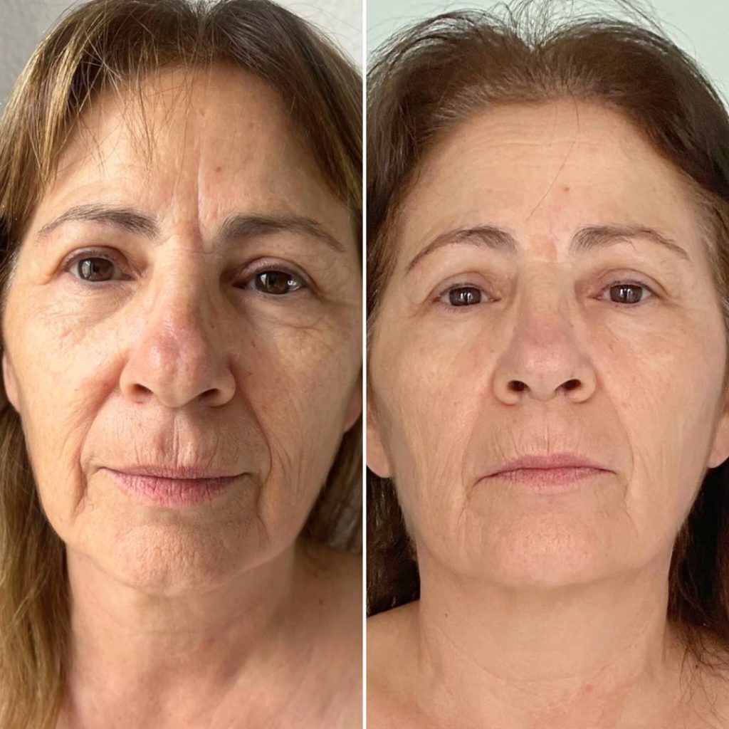 Non-Surgical HIFU