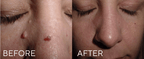 CRYOPEN SKIN LESION REMOVAL
