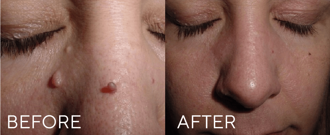 CRYOPEN FOR LESION REMOVAL