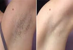 Laser Hair Removal