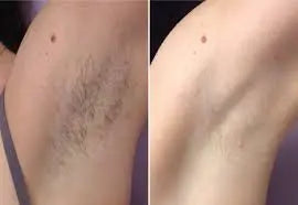 Laser Hair Removal