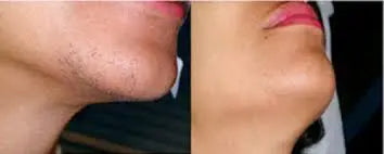 Laser Hair Removal