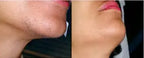 Laser Hair Removal