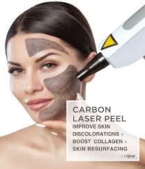 Carbon Laser Peel Treatment