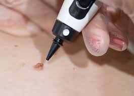 CryoPen Freeze Treatment
