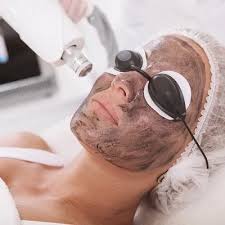 Carbon Laser Peel Treatment