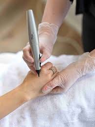 CryoPen Freeze Treatment