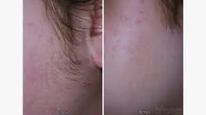 Laser Hair Removal
