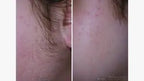 Laser Hair Removal