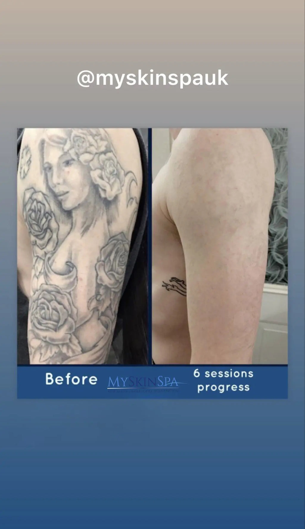 Tattoo Removal Pico Laser