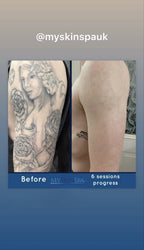 Tattoo Removal Pico Laser