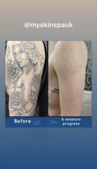 Tattoo Removal Pico Laser