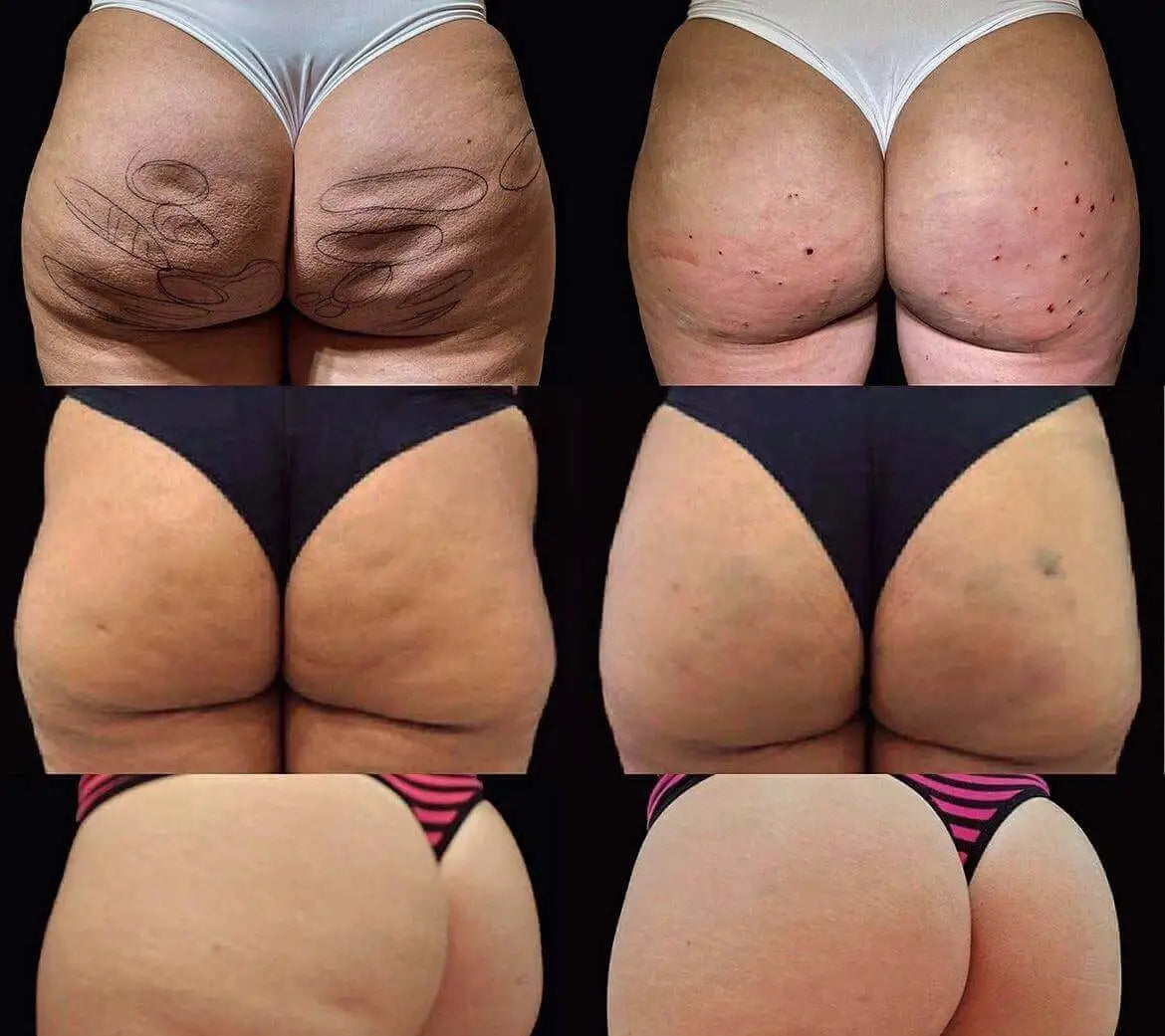 Cellulite Reduction